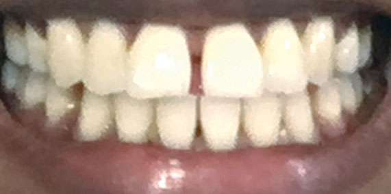 EZ SMILE Before & After
