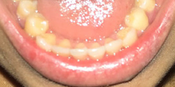 EZ SMILE Before & After