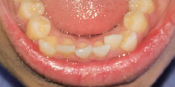 EZ SMILE Before & After