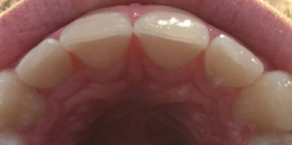 EZ SMILE Before & After