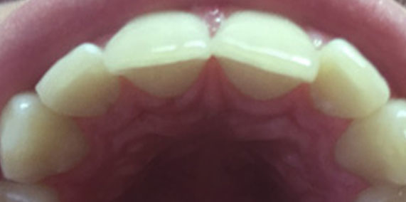 EZ SMILE Before & After