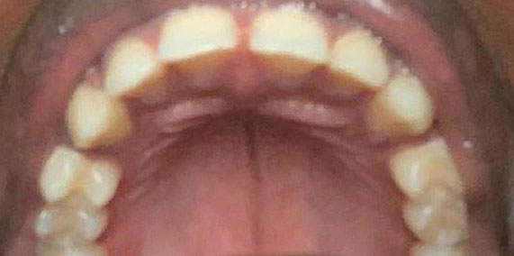 EZ SMILE Before & After